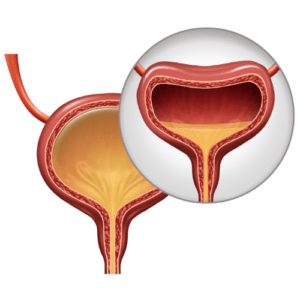 Incontinencia urinaria en esclerosis multiple